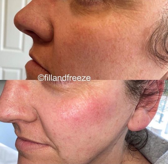 Before & After – Fill ‘n’ Freeze